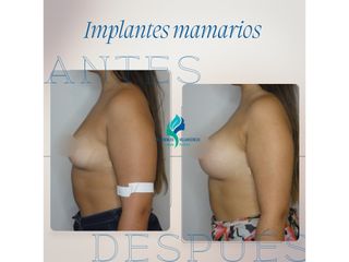 Aumento mamario - Dr. Rodolfo Villavicencio