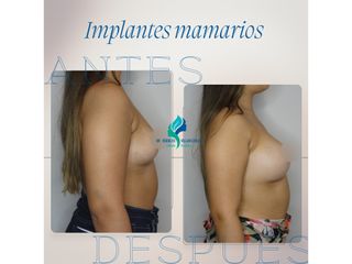 Aumento mamario - Dr. Rodolfo Villavicencio