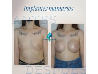 Pre y Postoperatorio de 2 meses de implantes mamarios 335 cc