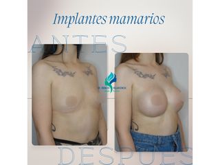 Pre y Postoperatorio de 2 meses de implantes mamarios 335 cc