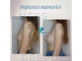 Pre y Postoperatorio de 2 meses de implantes mamarios 335 cc