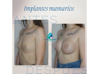 Pre y Postoperatorio de 2 meses de implantes mamarios 335 cc