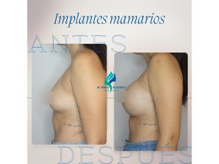 Aumento mamario - Dr. Rodolfo Villavicencio