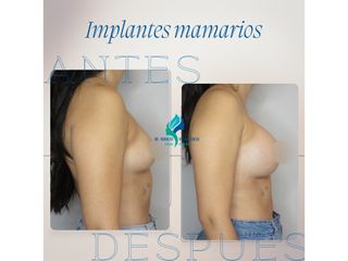 Aumento mamario - Dr. Rodolfo Villavicencio