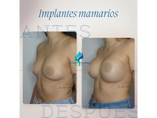 Aumento mamario - Dr. Rodolfo Villavicencio