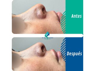 Tratamiento de punta nasal - Dr. Rodolfo Villavicencio