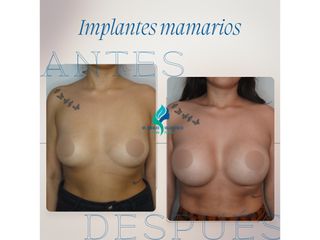 Aumento mamario - Dr. Rodolfo Villavicencio