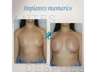 Aumento mamario - Dr. Rodolfo Villavicencio