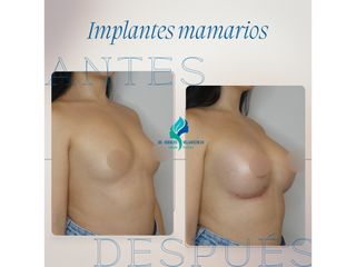 Aumento mamario - Dr. Rodolfo Villavicencio