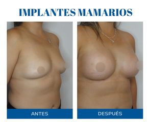 Aumento mamas - Dr. Rodolfo Villavicencio