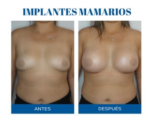 Aumento mamas - Dr. Rodolfo Villavicencio