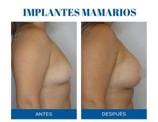 Aumento mamas - Dr. Rodolfo Villavicencio