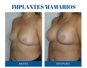 Aumento mamas - Dr. Rodolfo Villavicencio