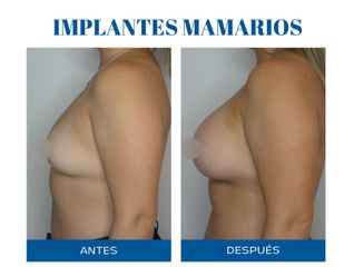 Aumento mamas - Dr. Rodolfo Villavicencio
