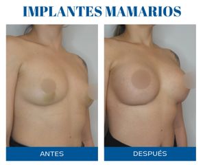 Aumento mamas - Dr. Rodolfo Villavicencio