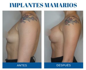 Aumento mamas - Dr. Rodolfo Villavicencio