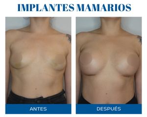 Aumento mamas - Dr. Rodolfo Villavicencio