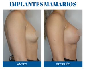 Aumento mamas - Dr. Rodolfo Villavicencio