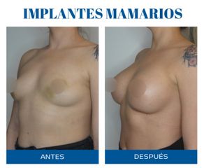 Aumento mamas - Dr. Rodolfo Villavicencio