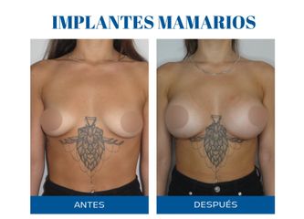 Aumento mamas - Dr. Rodolfo Villavicencio