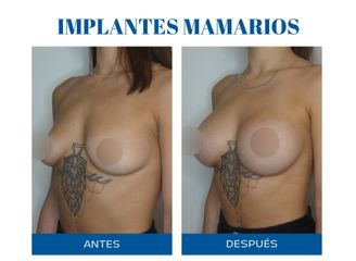 Aumento mamas - Dr. Rodolfo Villavicencio