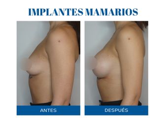 Aumento mamas - Dr. Rodolfo Villavicencio