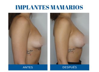Aumento mamas - Dr. Rodolfo Villavicencio