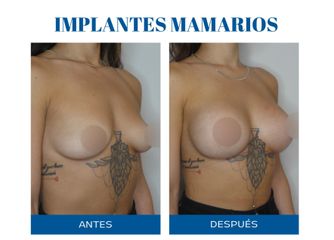 Aumento mamas - Dr. Rodolfo Villavicencio