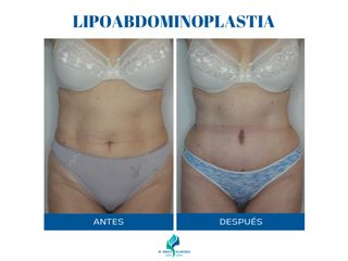 Lipoabdominoplastia - Dr. Rodolfo Villavicencio
