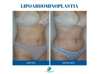 Lipoabdominoplastia - Dr. Rodolfo Villavicencio
