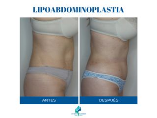 Lipoabdominoplastia - Dr. Rodolfo Villavicencio