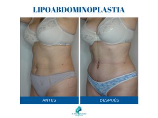 Lipoabdominoplastia - Dr. Rodolfo Villavicencio