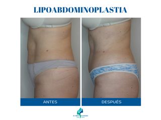 Lipoabdominoplastia - Dr. Rodolfo Villavicencio