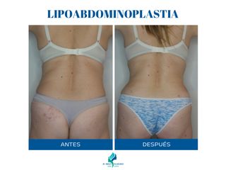 Lipoabdominoplastia - Dr. Rodolfo Villavicencio