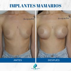 Aumento mamas - Dr. Rodolfo Villavicencio