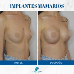 Aumento mamas - Dr. Rodolfo Villavicencio