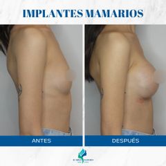 Aumento mamas - Dr. Rodolfo Villavicencio