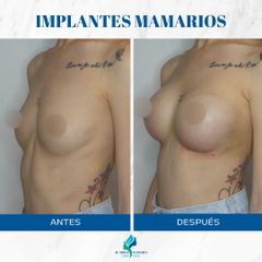 Aumento mamas - Dr. Rodolfo Villavicencio