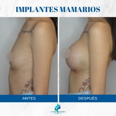 Aumento mamas - Dr. Rodolfo Villavicencio