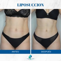 Liposucción - Dr. Rodolfo Villavicencio