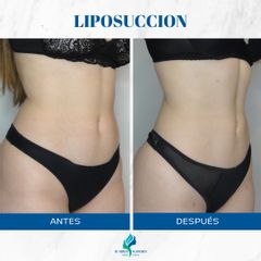 Liposucción - Dr. Rodolfo Villavicencio