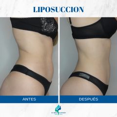 Liposucción - Dr. Rodolfo Villavicencio