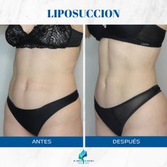 Liposucción - Dr. Rodolfo Villavicencio
