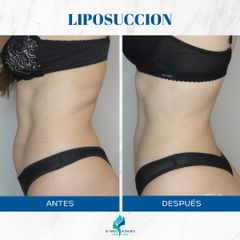 Liposucción - Dr. Rodolfo Villavicencio