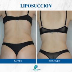 Liposucción - Dr. Rodolfo Villavicencio