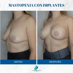 Mastopexia con Implantes - Dr. Rodolfo Villavicencio