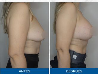 Mastopexia antes y después - 866949