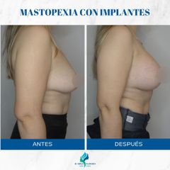 Mastopexia con Implantes - Dr. Rodolfo Villavicencio