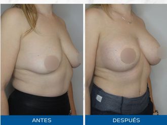 Mastopexia antes y después - 866950