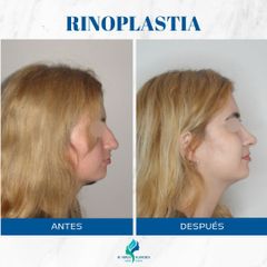 Rinoplastia - Dr. Rodolfo Villavicencio